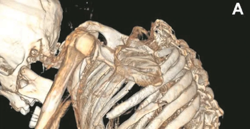 Derrumbe: Revelan causa de muerte de minero prehispánico del Desierto de Atacama